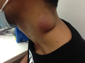 Neck lump in a young man