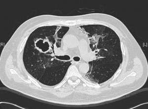 CT thorax of the man with prior RSV pneumonitis.