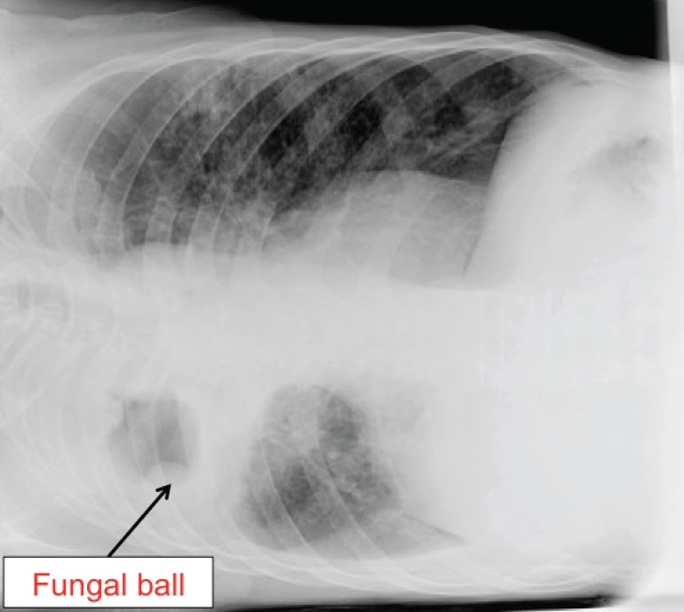 Chest X-ray with patient in the right lateral recumbent position. The fungal ball has "fallen" by gravity.
