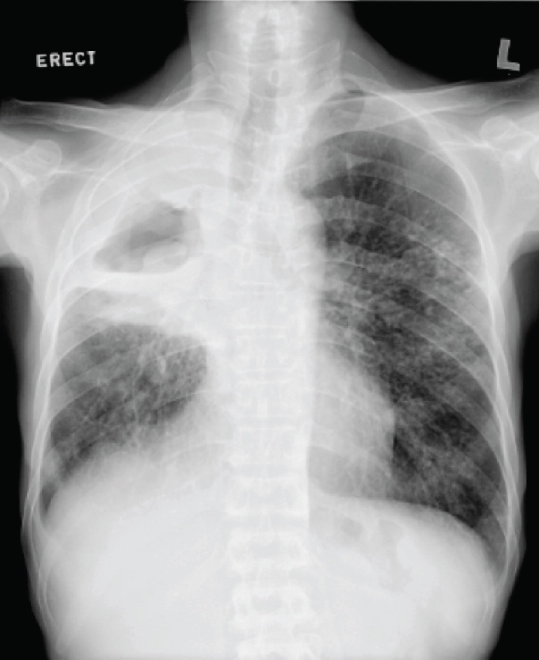 Chest X-ray of the elderly gentleman with prior tuberculosis and current hemoptysis.