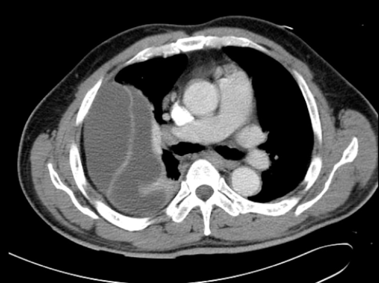 CT thorax - massive right pleural effusion with loculation.