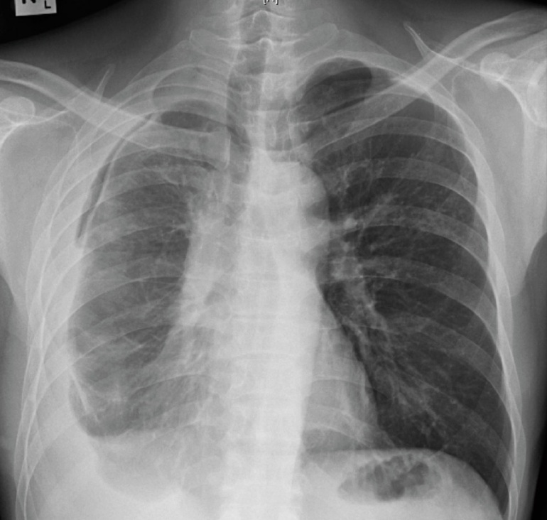 Chest X-ray taken 10 days later, after a diagnostic pleural tap and drainage had been performed.