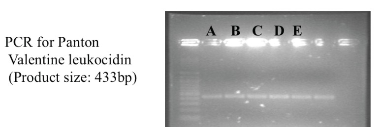 Gel electrophoresis showing positive PCR products for Panton-Valentine Leukocidin for the 5 initial CA-MRSA isolates in Singapore.